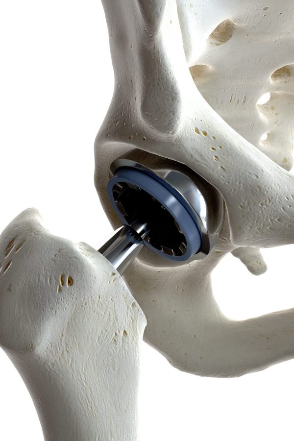 3d rendered medically accurate illustration of a hip replacement